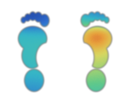 Thermal scan of a left and right foot; the right forefoot is warmer, with a red hotspot